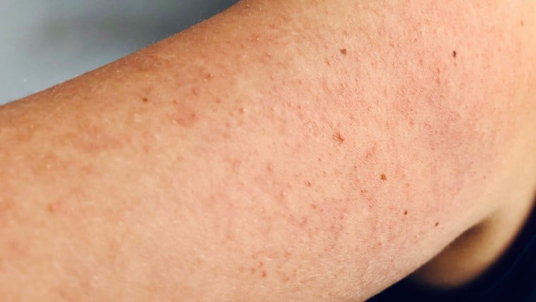 Reibeisenhaut, Keratosis Pilaris, Keratosis Pilaris Behandlung, Verhörnungsstörung, Pickel an den Oberarmen, Beauty Tipps, Hautpflege, ElisaZunder Blogazine,